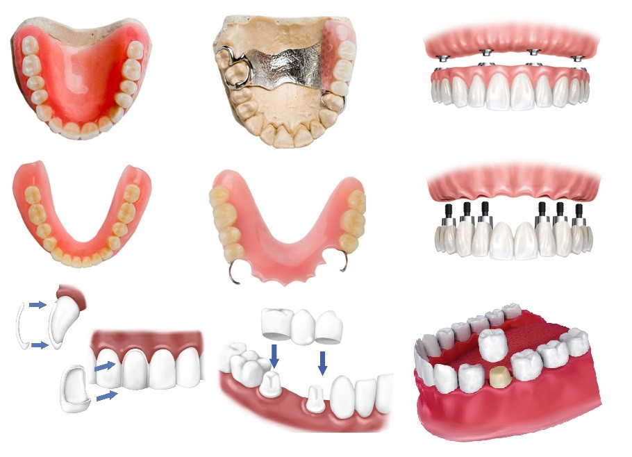 Особенности протезирования зубов в стоматологической клинике «ЭвриСтом»